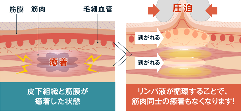 皮下組織と筋膜の癒着を剥がし体の正常な機能を取り戻します。